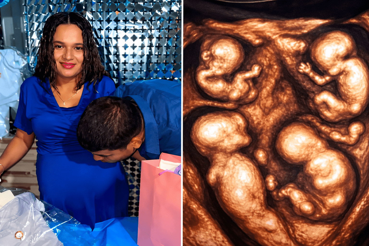 Cuatrillizos, una misma placenta: el extraordinario embarazo que lleva a una pareja de Caucasia a Medellín